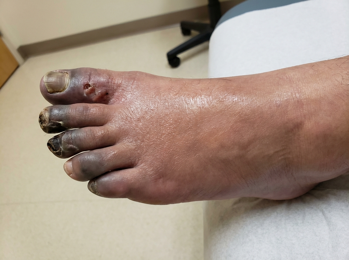 Clinical photograph of a foot with severe digital ischemia and early gangrene